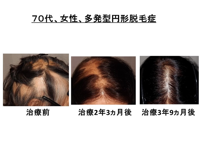 円形脱毛症　病院